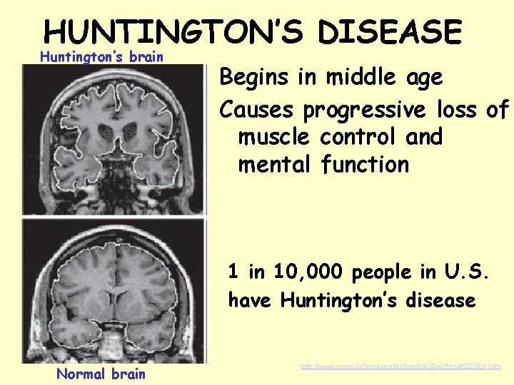 HUNTINGTON’S DISEASE Huntington’s brain Begins in middle age Causes progressive loss of muscle control