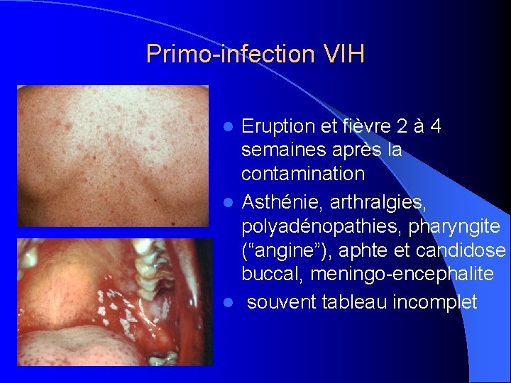 Primo-infection VIH Eruption et fièvre 2 à 4 semaines après la contamination l Asthénie,