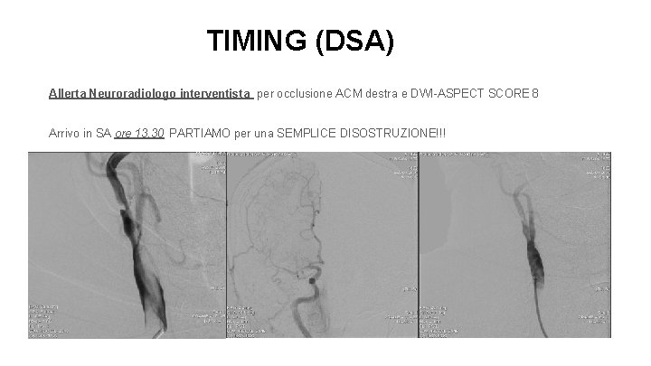 TIMING (DSA) Allerta Neuroradiologo interventista per occlusione ACM destra e DWI-ASPECT SCORE 8 Arrivo