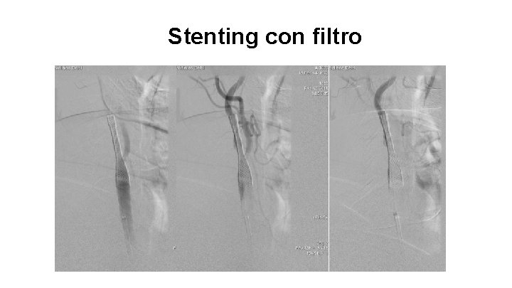 Stenting con filtro 