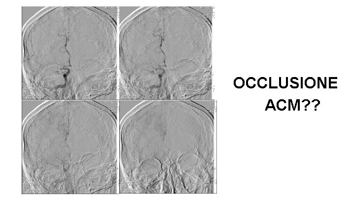 OCCLUSIONE ACM? ? 