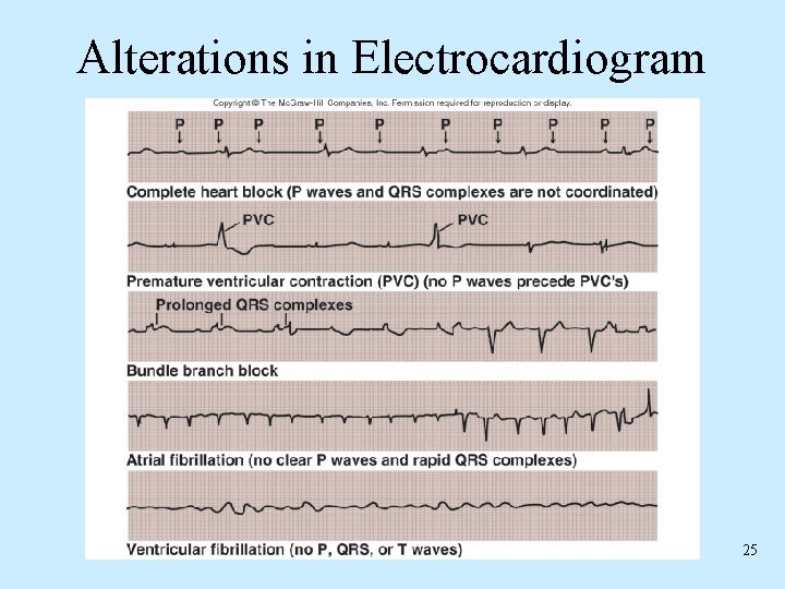 Alterations in Electrocardiogram 25 