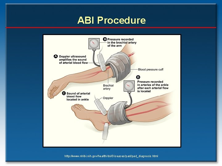 ABI Procedure http: //www. nhlbi. nih. gov/health/dci/Diseases/pad_diagnosis. html 