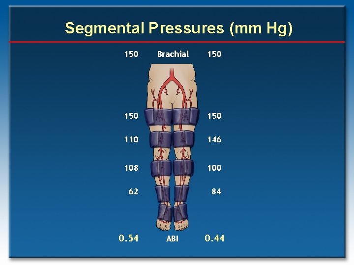 Segmental Pressures (mm Hg) 150 Brachial 150 150 110 146 108 100 62 84