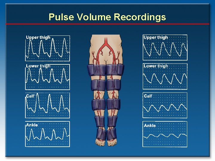 Pulse Volume Recordings 