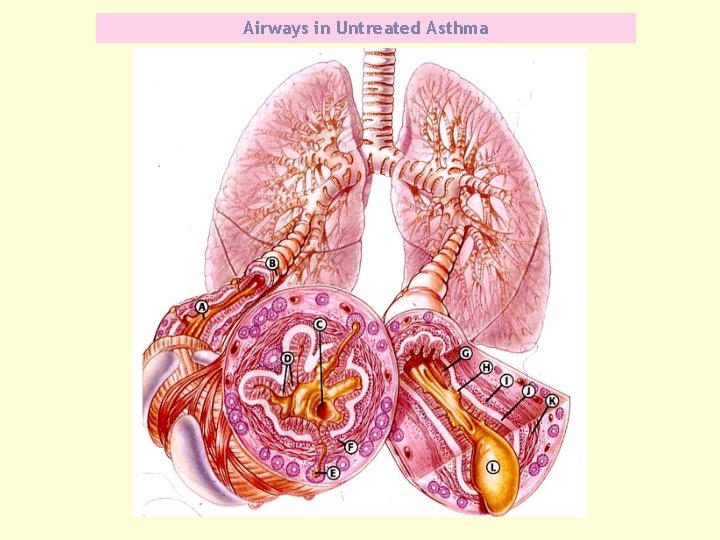 Airways in Untreated Asthma 