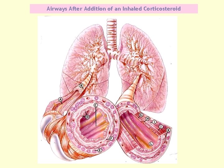  Airways After Addition of an Inhaled Corticosteroid 