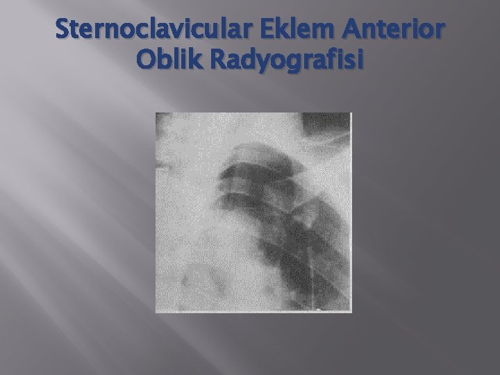 Sternoclavicular Eklem Anterior Oblik Radyografisi 