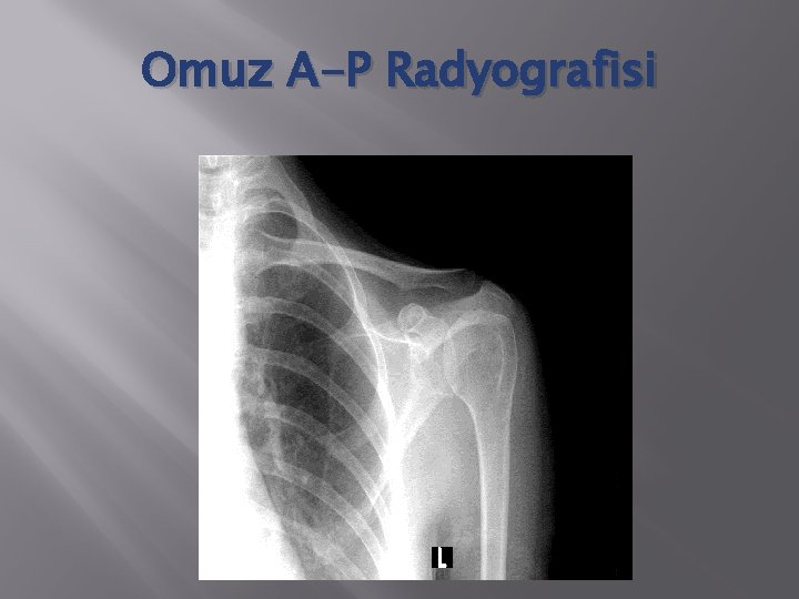 Omuz A-P Radyografisi 
