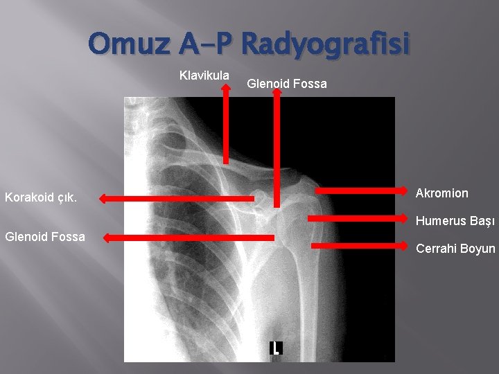 Omuz A-P Radyografisi Klavikula Korakoid çık. Glenoid Fossa Akromion Humerus Başı Glenoid Fossa Cerrahi