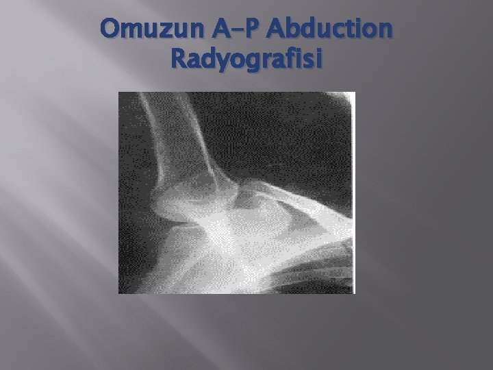 Omuzun A-P Abduction Radyografisi 