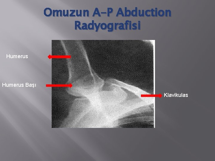 Omuzun A-P Abduction Radyografisi Humerus Başı Klavikulas 