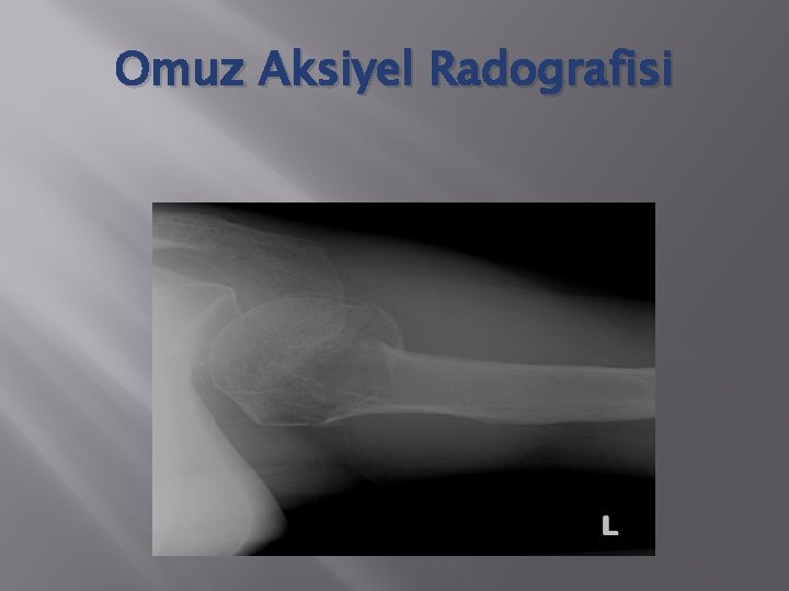 Omuz Aksiyel Radografisi 