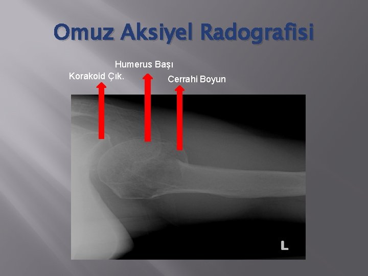 Omuz Aksiyel Radografisi Humerus Başı Korakoid Çık. Cerrahi Boyun 