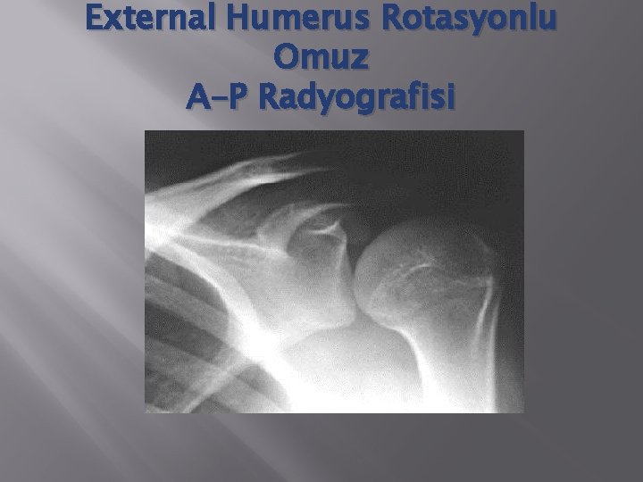 External Humerus Rotasyonlu Omuz A-P Radyografisi 