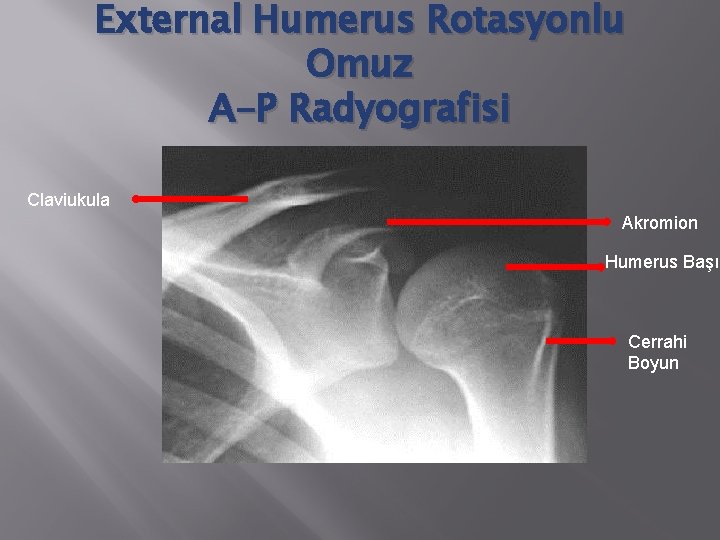 External Humerus Rotasyonlu Omuz A-P Radyografisi Claviukula Akromion Humerus Başı Cerrahi Boyun 