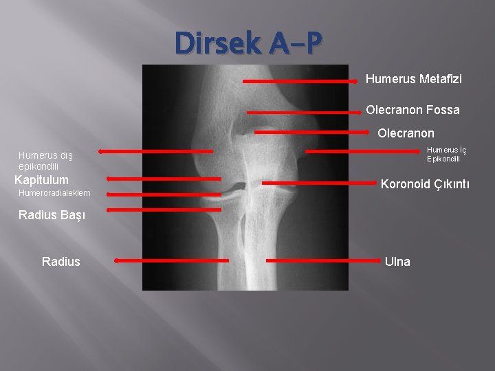 Dirsek A-P Humerus Metafizi Olecranon Fossa Olecranon Humerus İç Epikondili Humerus dış epikondili Kapitulum