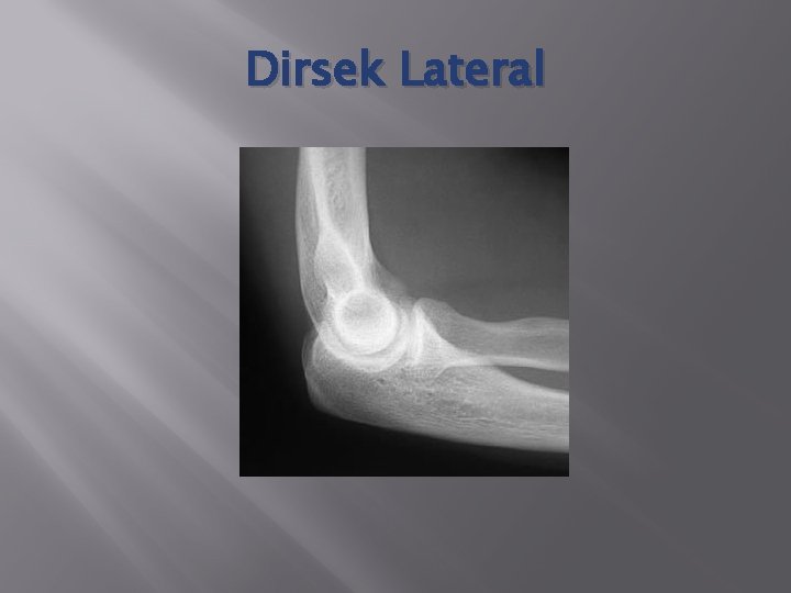 Dirsek Lateral 