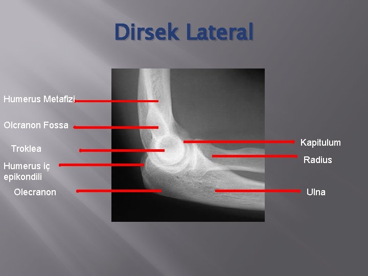 Dirsek Lateral Humerus Metafizi Olcranon Fossa Troklea Humerus iç epikondili Olecranon Kapitulum Radius Ulna