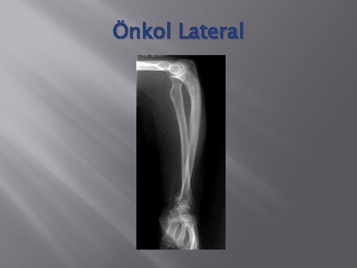 Önkol Lateral 