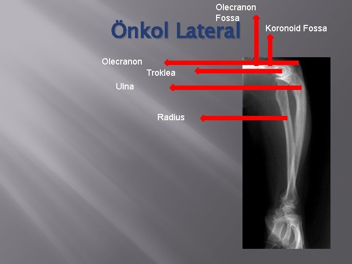 Olecranon Fossa Önkol Lateral Olecranon Troklea Ulna Radius Koronoid Fossa 