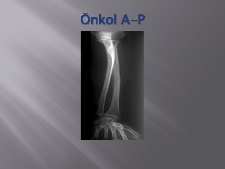 Önkol A-P 