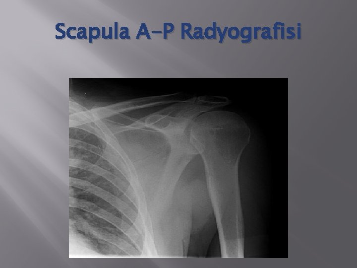 Scapula A-P Radyografisi 