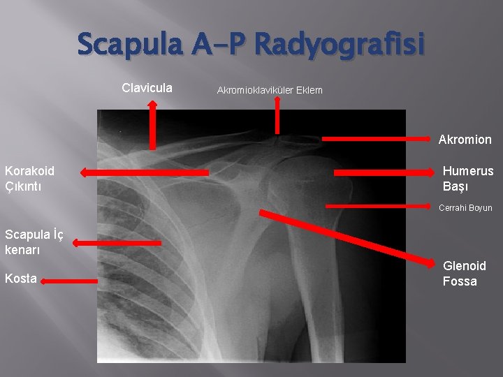 Scapula A-P Radyografisi Clavicula Akromioklaviküler Eklem Akromion Korakoid Çıkıntı Humerus Başı Cerrahi Boyun Scapula