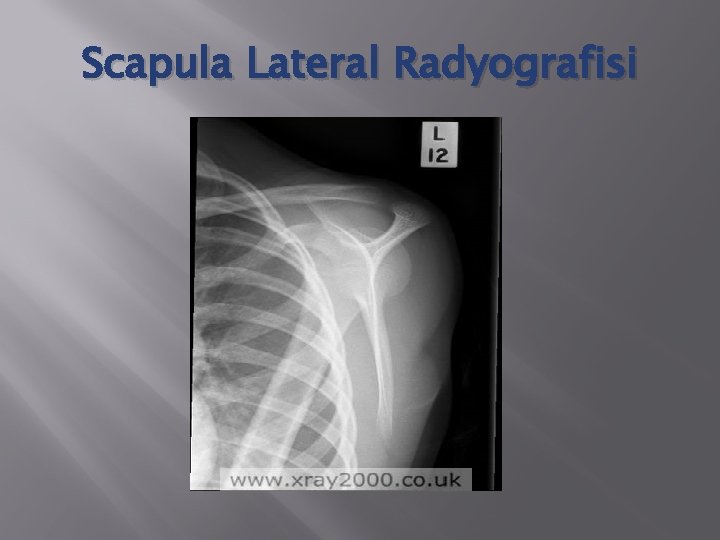 Scapula Lateral Radyografisi 