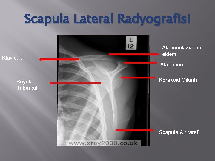 Scapula Lateral Radyografisi Klavicula Akromioklaviüler eklem Akromion Büyük Tüberkül Korakoid Çıkıntı Scapula Alt tarafı