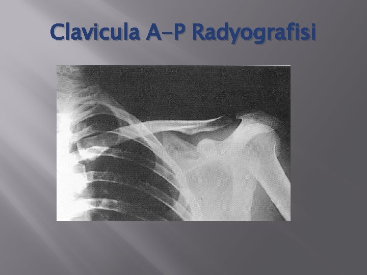 Clavicula A-P Radyografisi 