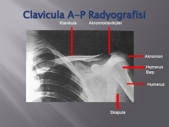 Clavicula A-P Radyografisi Klavikula Akromioklaviküler Akromion Humerus Başı Humerus Skapula 