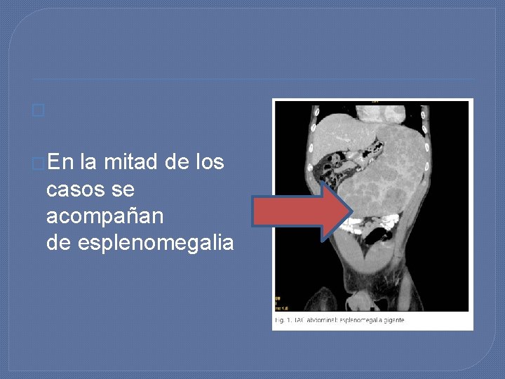 � �En la mitad de los casos se acompañan de esplenomegalia � �En la mitad de los casos se acompañan de esplenomegalia