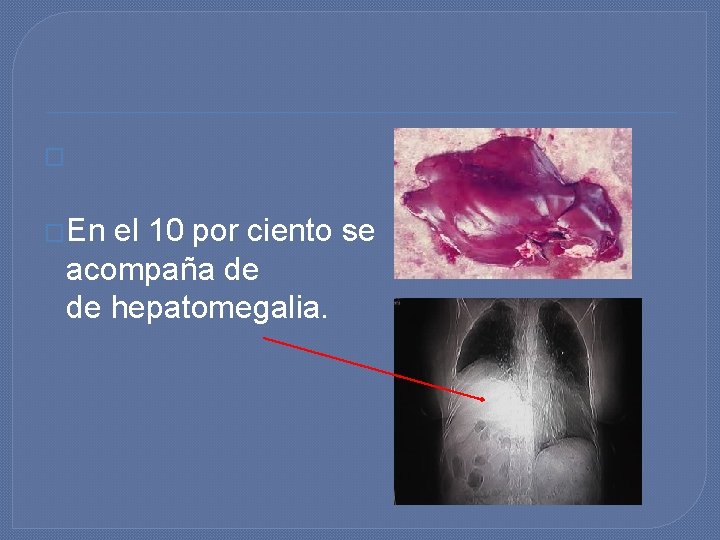 � �En el 10 por ciento se acompaña de de hepatomegalia. � �En el 10 por ciento se acompaña de de hepatomegalia.