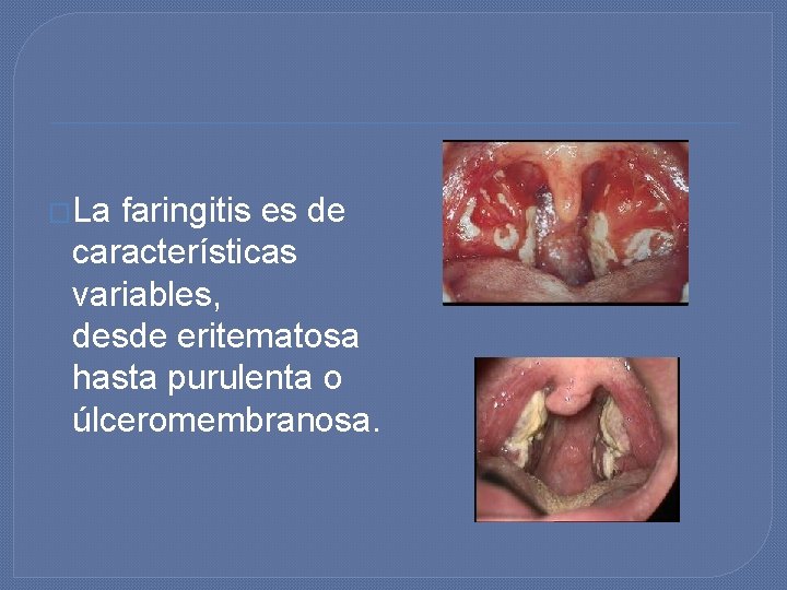 �La faringitis es de características variables, desde eritematosa hasta purulenta o úlceromembranosa. �La faringitis es de características variables, desde eritematosa hasta purulenta o úlceromembranosa.