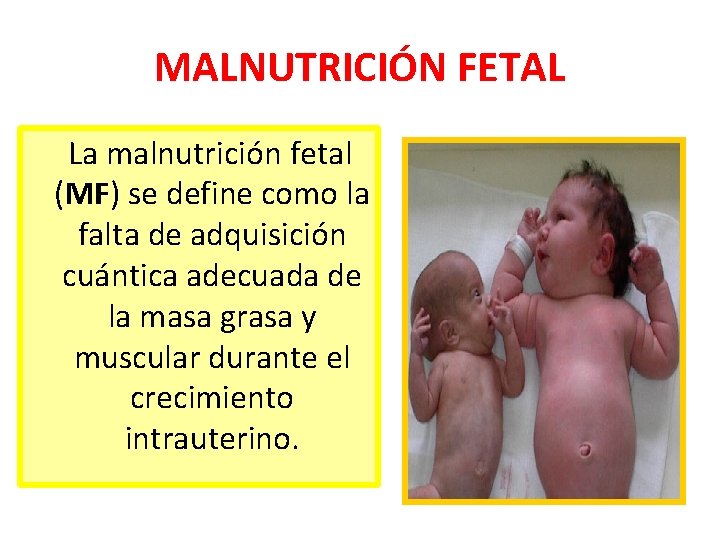 MALNUTRICIÓN FETAL La malnutrición fetal (MF) se define como la falta de adquisición cuántica MALNUTRICIÓN FETAL La malnutrición fetal (MF) se define como la falta de adquisición cuántica