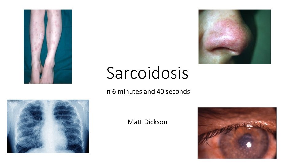 Sarcoidosis in 6 minutes and 40 seconds Matt Dickson 