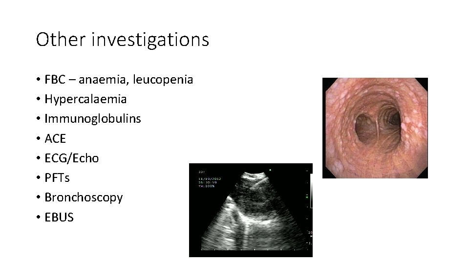 Other investigations • FBC – anaemia, leucopenia • Hypercalaemia • Immunoglobulins • ACE •