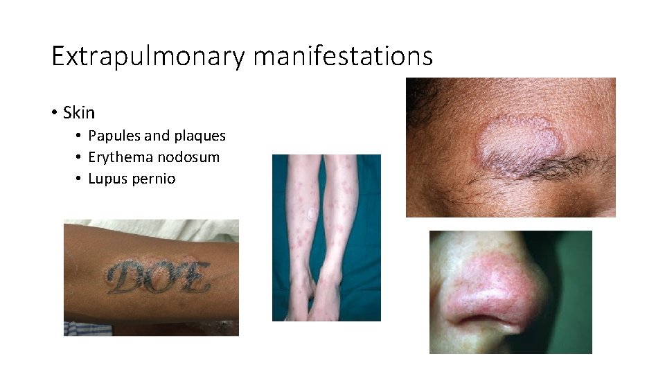 Extrapulmonary manifestations • Skin • Papules and plaques • Erythema nodosum • Lupus pernio