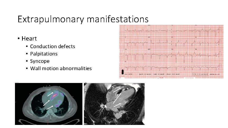 Extrapulmonary manifestations • Heart • • Conduction defects Palpitations Syncope Wall motion abnormalities 