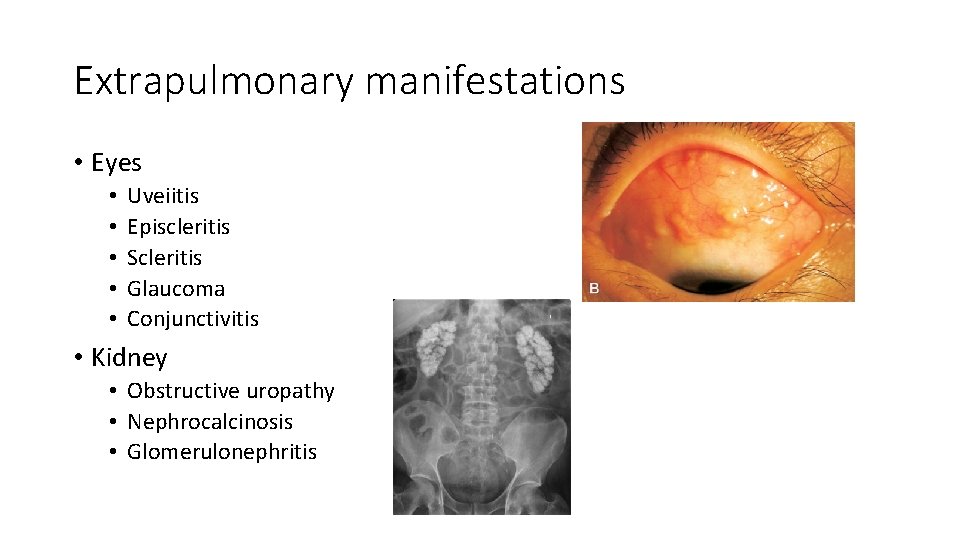 Extrapulmonary manifestations • Eyes • • • Uveiitis Episcleritis Scleritis Glaucoma Conjunctivitis • Kidney