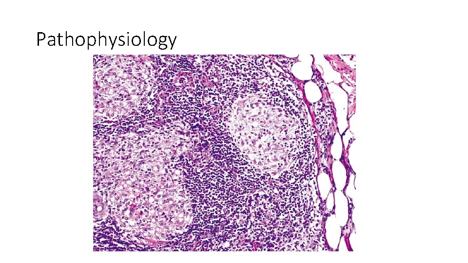 Pathophysiology 