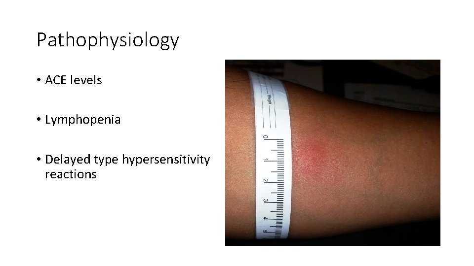 Pathophysiology • ACE levels • Lymphopenia • Delayed type hypersensitivity reactions 