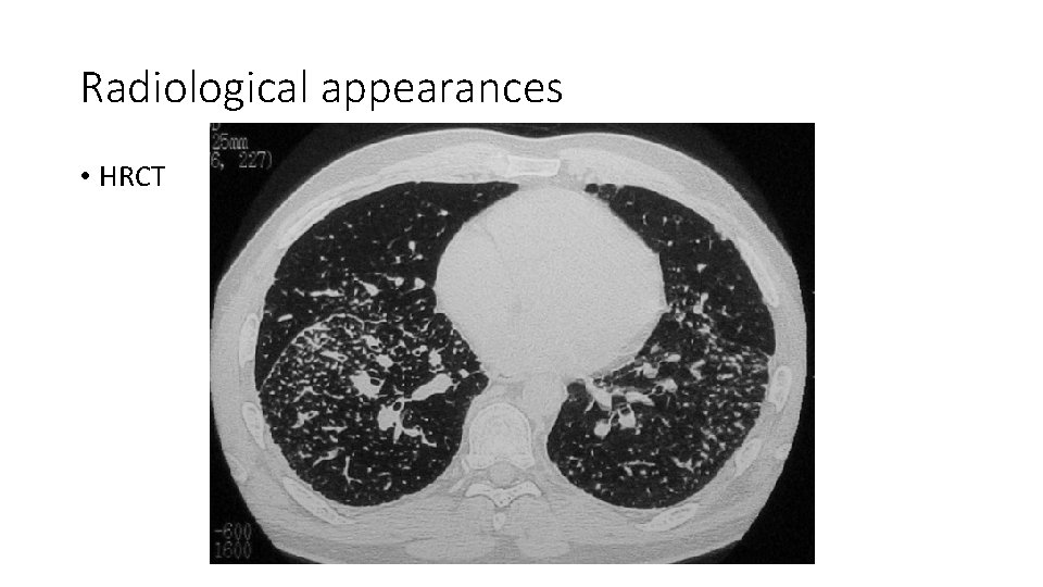 Radiological appearances • HRCT 