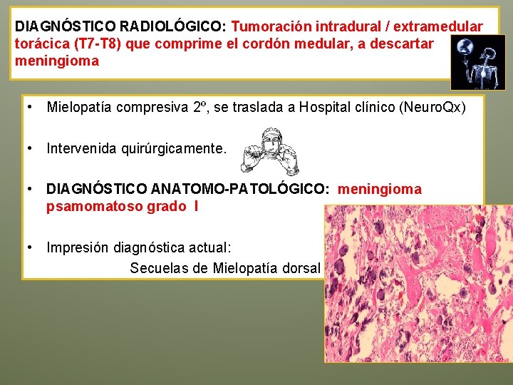 DIAGNÓSTICO RADIOLÓGICO: Tumoración intradural / extramedular torácica (T 7 -T 8) que comprime el