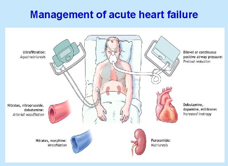 Management of acute heart failure 52 
