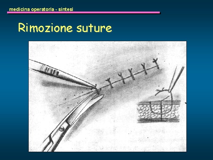 medicina operatoria - sintesi Rimozione suture 