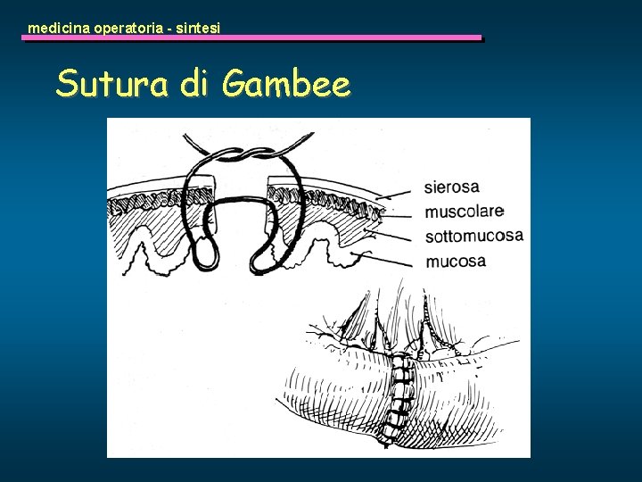 medicina operatoria - sintesi Sutura di Gambee 