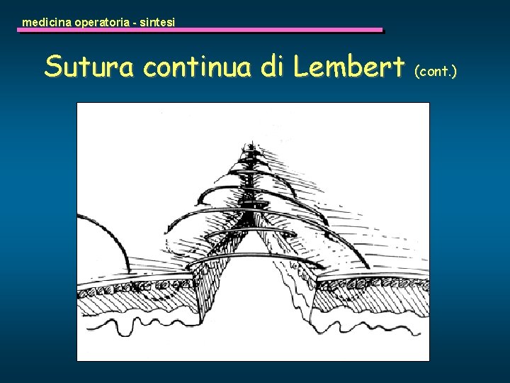 medicina operatoria - sintesi Sutura continua di Lembert (cont. ) 