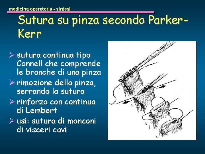 medicina operatoria - sintesi Sutura su pinza secondo Parker. Kerr Ø sutura continua tipo